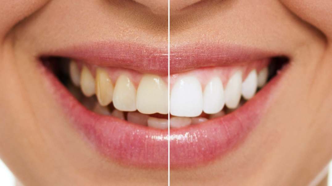 Veneto Dental Care : Teeth Whitening in Miramar, FL