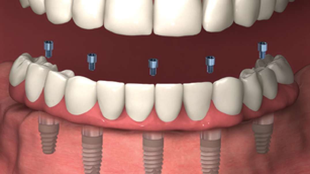 Apple Dental Group : Dental Implants in Miami Springs, FL | 305-884-2751