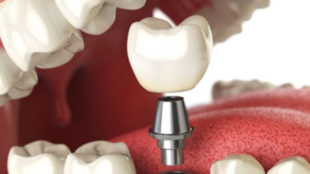 DB Dental Care : Best Dental Implant in Miami, FL | (786) 418-6757