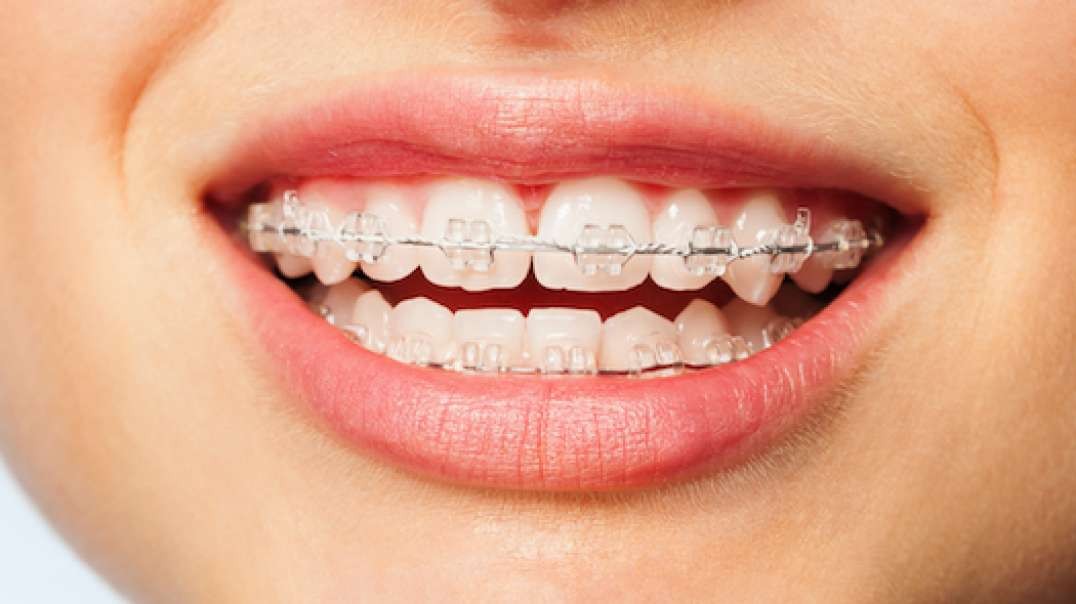 Cool SmilesZ : Dental Braces Cost in Coral Gables