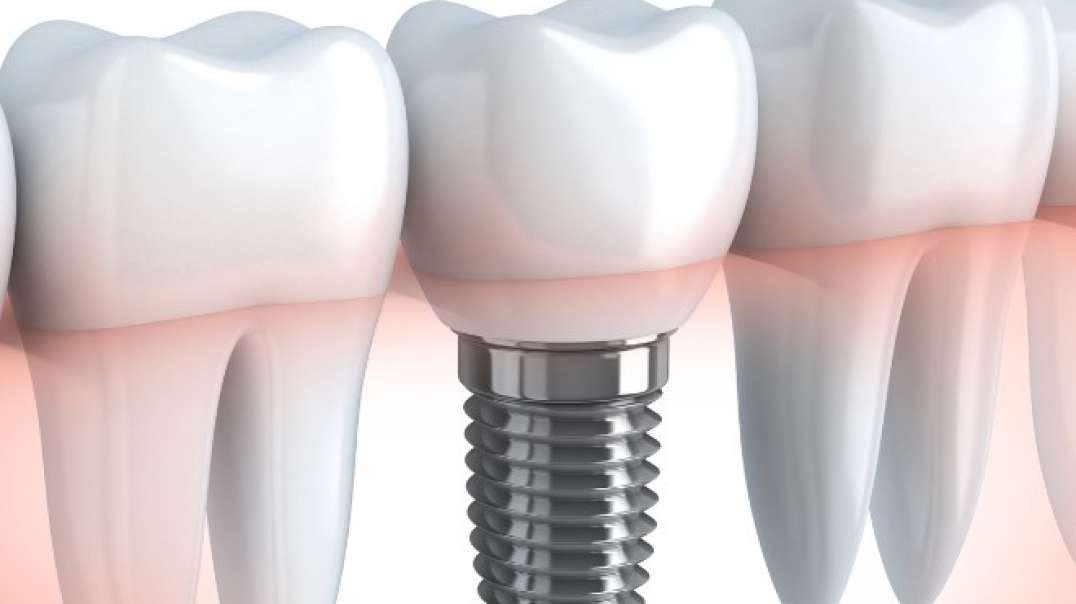 Elite Smiles Dental Center : Dental Implants in Miami, FL