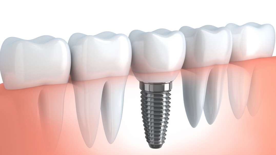 Advanced Dentistry of Coral Springs : #1 Dental Implants in Coral Springs, FL | (954) 997-5147