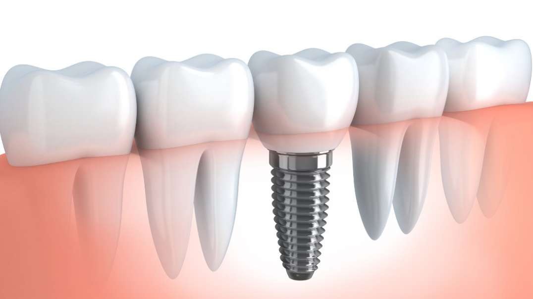 Rielo Dental Clinic : #1 Dental Implants in Hialeah, FL | 305-231-5455
