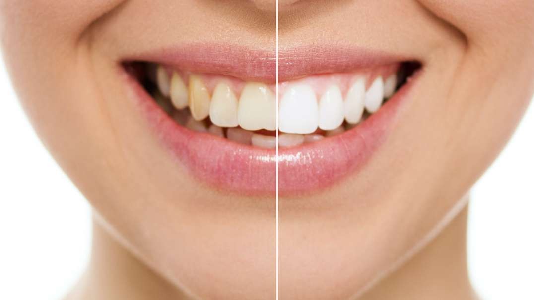 Elite Smiles Dental Center : Teeth Whitening in Miami, FL