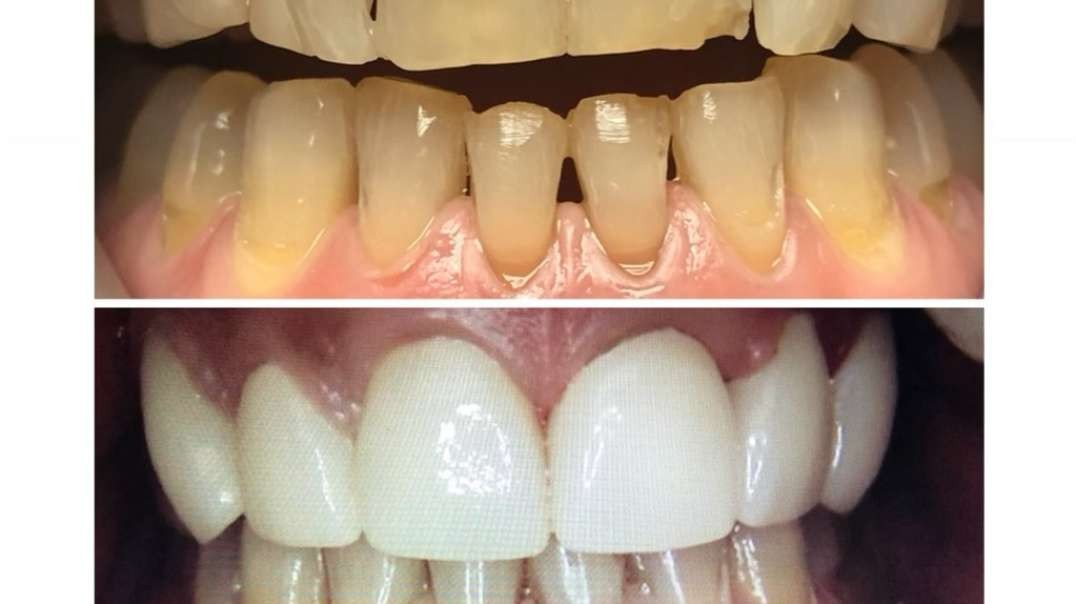Pembroke Pines Dental Health Center : Professional Teeth Whitening in Pembroke Pines, FL
