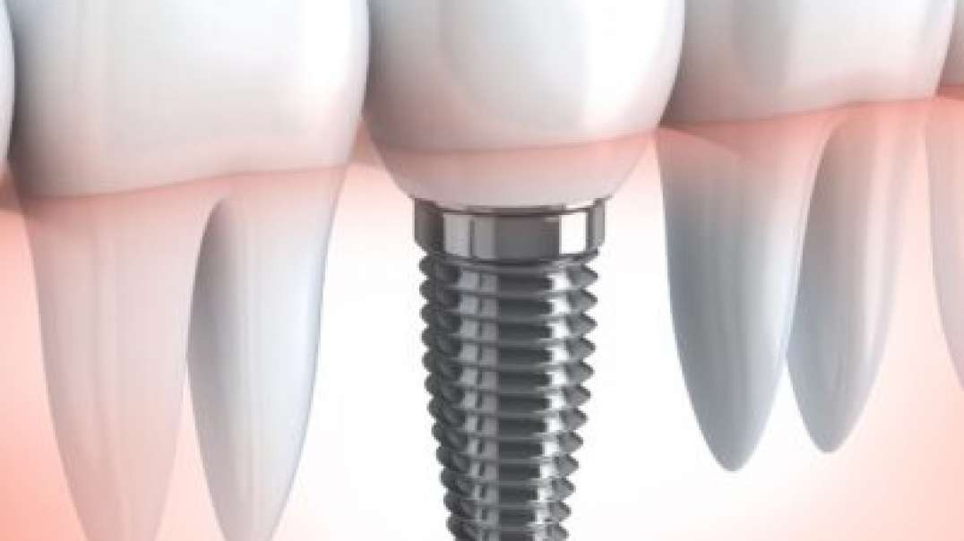 Miami Lakes Dental Health Center : All ON 6 Dental Implants in Miami Lakes